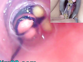 Of age Woman, Peehole Endoscope Camera round Bladder with Balls